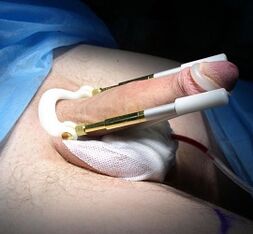 How is a transaction to increase the penis