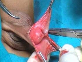 Male genital augmentation surgery