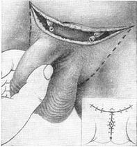 Surgical extension of the hidden part of the penis